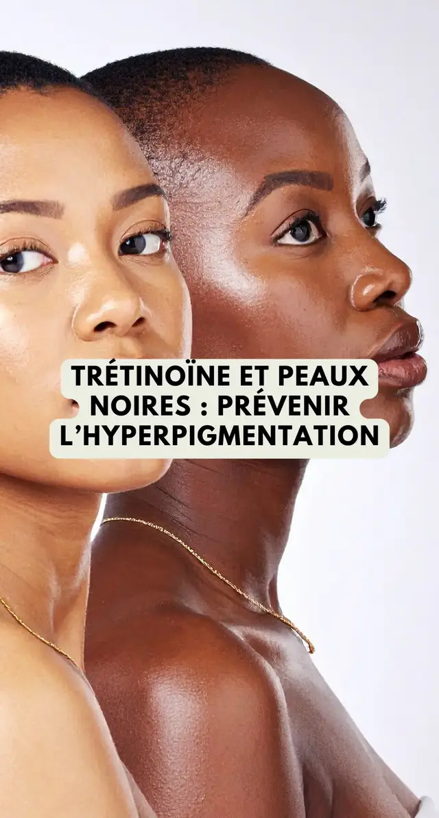 La trétinoïne est un rétinoïde de référence en dermatologie mais sur les peaux noires, son introduction demande une stratégie rigoureuse afin d’éviter le risque de PIH (l’hyperpigmentation post-inflammatoire). Le protocole repose sur trois axes : démarrer avec une fréquence espacée, renforcer la barrière cutanée par l’hydratation et associer systématiquement une photoprotection quotidienne. Cette approche permet de bénéficier des effets prouvés de la trétinoïne tout en limitant ses effets indésirables sur l’uniformité du teint. #tretinoine #dermato #cosmetiques #beauty #hyperpigmentation 