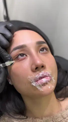 Bọng mắt tươi nào … bọng mắt tươi đi ce ơi 😙😙😙 #fillers💉 #lamdep #haiphong #botox #thammy 