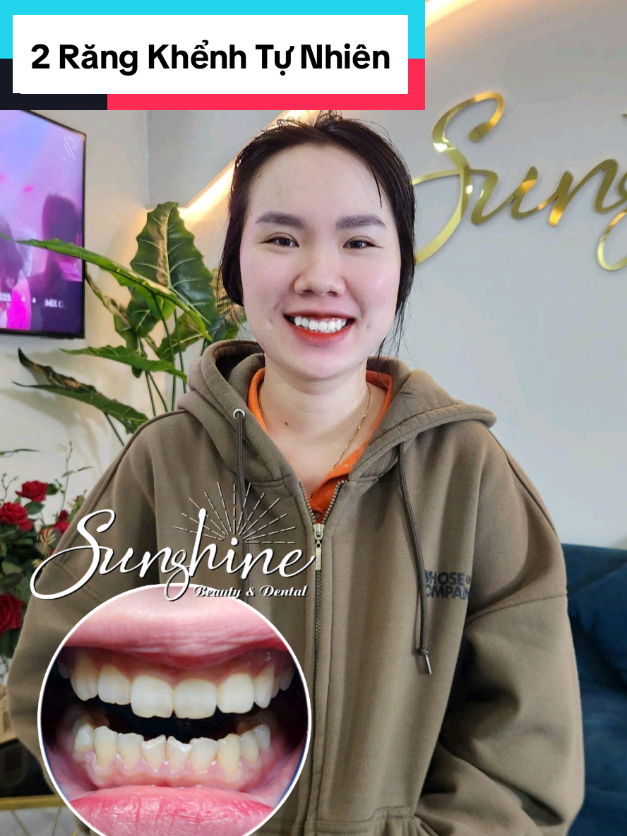 ⚜️Răng Khểnh Tự Nhiên 3️⃣5️⃣0️⃣🐟(ko mài nhỏ Răng) cho em gái xinh🥰🥰🥰 #sunshinebeauty #răng_khểnh #răngkhenh #đắp_răng_khểnh #xuhuong 