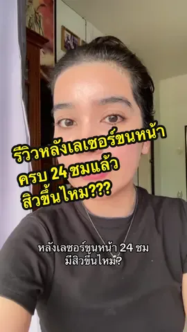 ตอบกลับ @ชื่ออ๋อมเฉยๆ ไม่ใช่อ๋อมแอ๋ม โบกมอยส์หนักมากหลังเลเซอร์ไม่มีสิวหรือผดเลย (มีแค่สิวและรอยรอยตรงแก้มซึ่งอ๋อมเป็นมาก่อนเลเซอร์นะคะ) #อ๋อมบิทรีวิว 