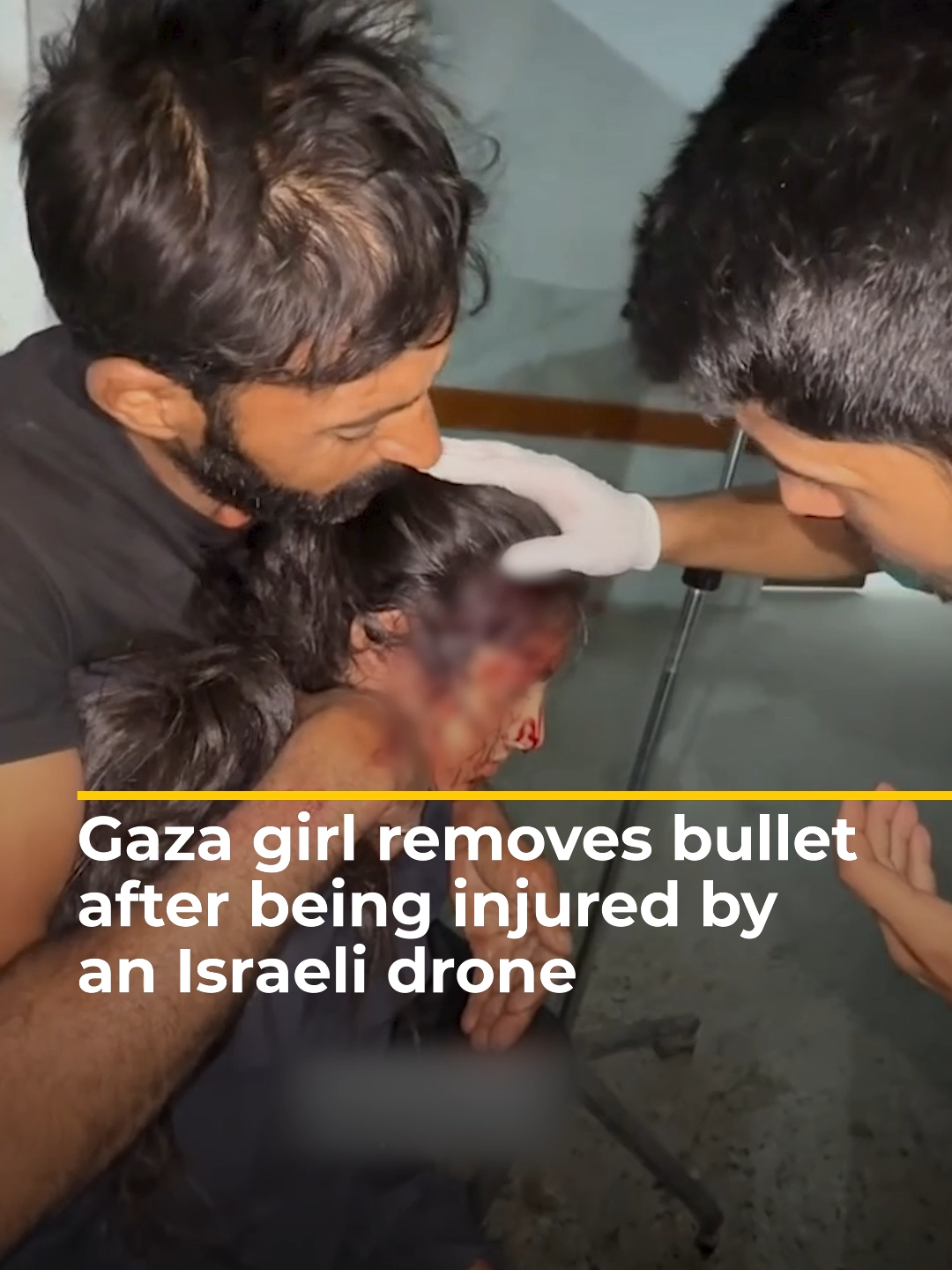 A Palestinian girl removed a ‘stray bullet’ that struck her in the head during an Israeli drone in Gaza city. #news