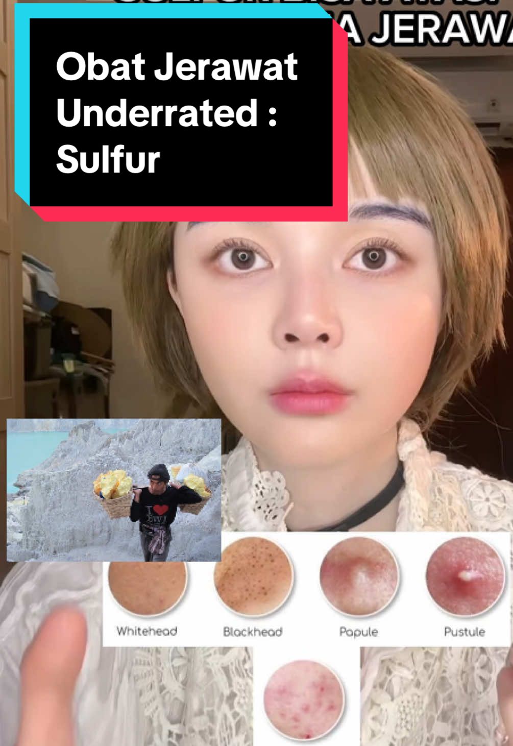 Iya sulfur yang di Ijen, di pemandian hangat belerang. Dulu terkenal banget untuk menyembuhkan berbagai penyakit tapi sekarang kan sudah modern ya jadinya bentuk sabun, skincare atau kalau pernah ke Ijen dijual belerang bentuk mainan itu bisa buat bacne atau jamur. Alasan jarang ada di skincare itu krn memang tidak menyenangkan, udah berbedak, dempul, bau lagi. Tapi yang skin game ini ga bau sih. Udah ada salicylic acid, zinc pca sama calamine jgZ Pakenya totol tebal ya #acnespot #sulfur #belerang #jerawat #acnefighter 