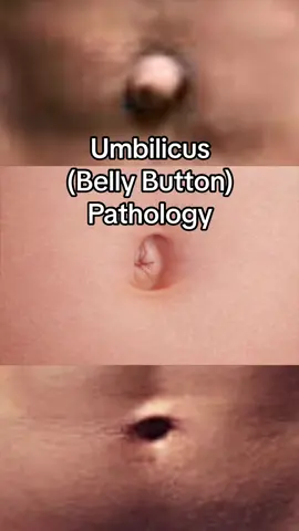 #Science #TikTokLearningCampaign  Belly button pathology