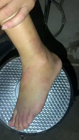 Bệnh nhân bị  chấn thương khi làm việc .. rạn xương bàn chân , tràn dịch, bầm tím khớp cổ chân . Đau nhức không đi lại  được