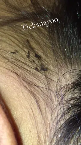 Remove lice #😭😭😭 #omg😱😱😱 #lice😰😰😰 #😂😂😂 #tripofobia😮😥 