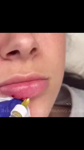 ليه يخربون نفسهم بالفلر 💔#fyp #filler #lip #viral 
