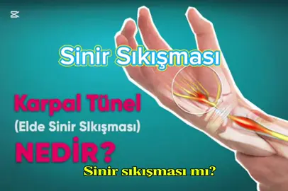 Sıkışan sinirlere değil, özgürlüğe yer aç!✅ #onemore #sinirsıkışması #painless #karpaltünel #karpaltünelsendromu 