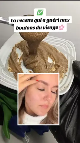 La recette qui a guéri mes boutons du visage #visage #recette #france #pourtoi 