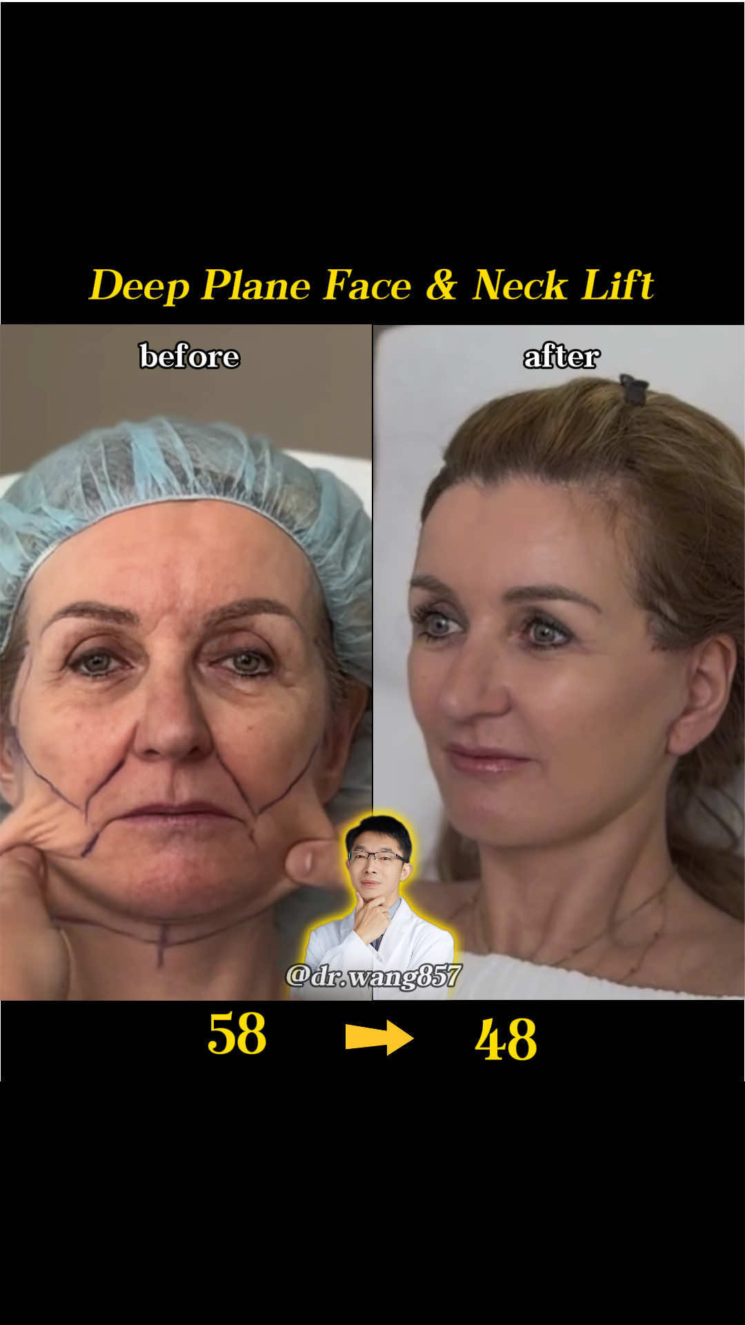 ✨ A Journey of Renewal ✨ My 58-year-old patient from the USA came in saying, “I just want to look like me again.” We chose a High-SMAS Facelift, restoring the deep fascia and supporting structures. Now, just weeks later, she looks refreshed, confident, and 10 years younger — without losing her natural charm. To me, the best facelift is one that brings someone’s inner energy back to the surface. #facelift #necklift #headlift #deepplanefacelift #highSMAS  