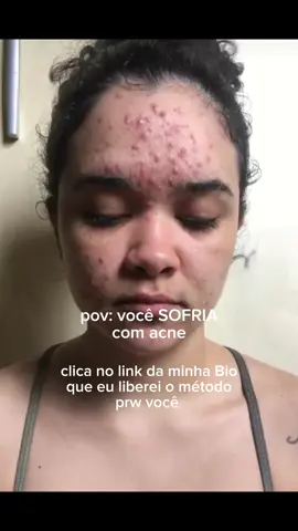 SOFRIA no passado mesmo, porque agora é só pele lisinha glass skin #acne #beauty #pele 