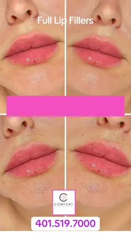 #lip#fillers #juvederm #hyaluronicacid #beforeandafter 