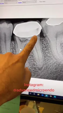 #dentalstudent #dentalhygienist #rootcanal #dentalofficelife #dentists 