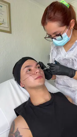 @clinicahebellsantiago ✨🧚🏻 #botox #acidohialuronico #armonizacionfacial 