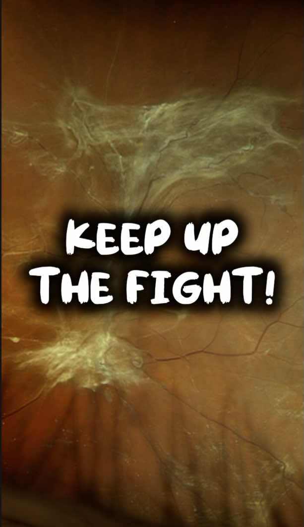 #stitch with @JustMe_Jas💕 Hey thanks for sharing. Keep up the fight! #ophthalmology #eyes #t1d #diabeticretinopathy 