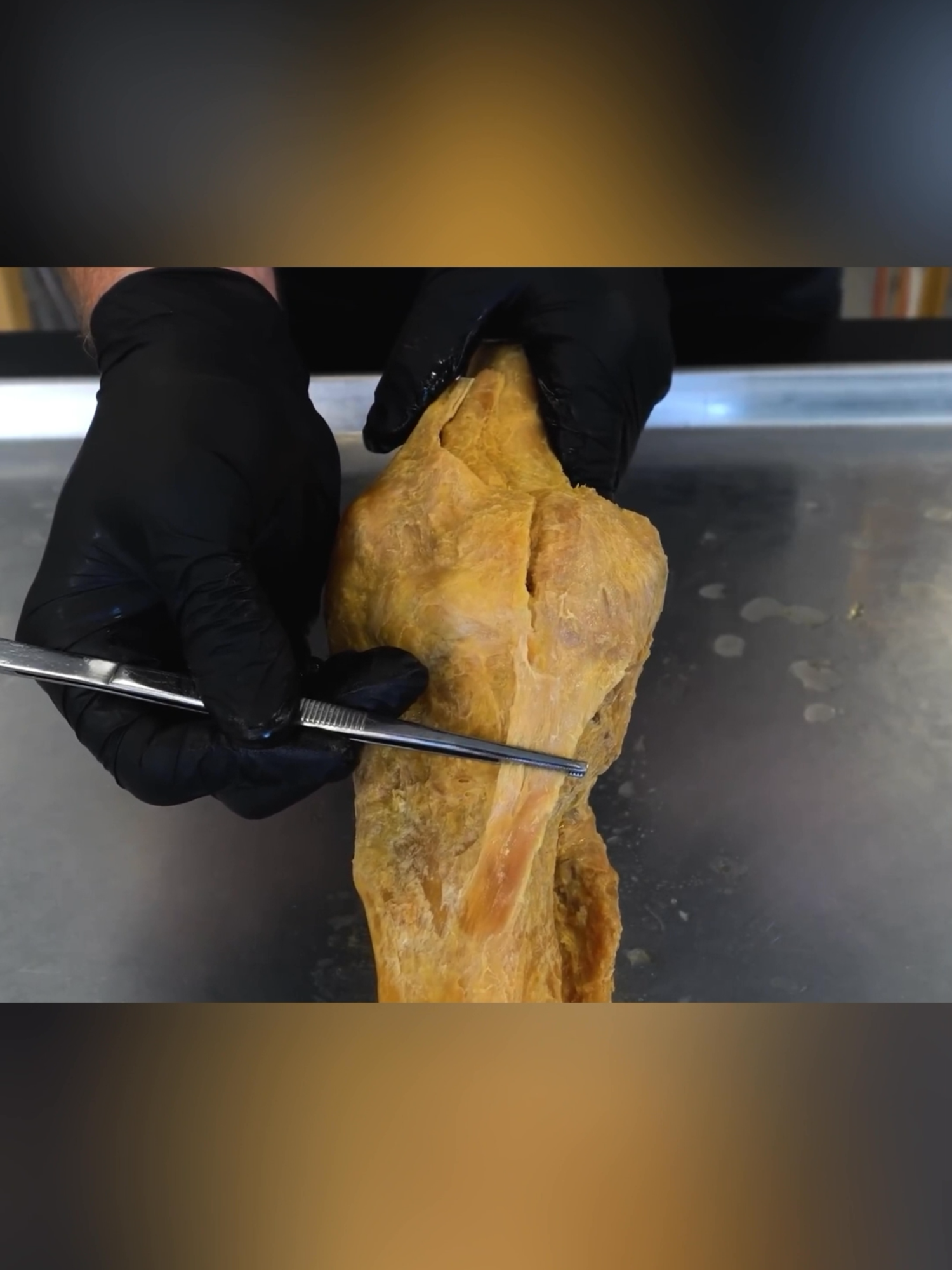 PART 1: Inside a Real Arthritic Knee - The Anatomy of Degeneration Looking at a real human knee with severe osteoarthritis to understand what's actually happening inside your joint. ORIENTATION: This is a right knee - patella (kneecap) at the front, femur (thighbone) above, tibia and fibula below. Fun fact: the fibula is the lateral bone - that 