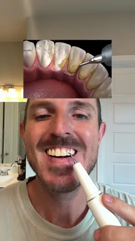 Oral plaque and tarter remover! Grab one while it’s still in stock and at a low price or grab it as a gift! #plaque #tarter #dentist #oralhealth #tiktokshopdealsforyoudays 