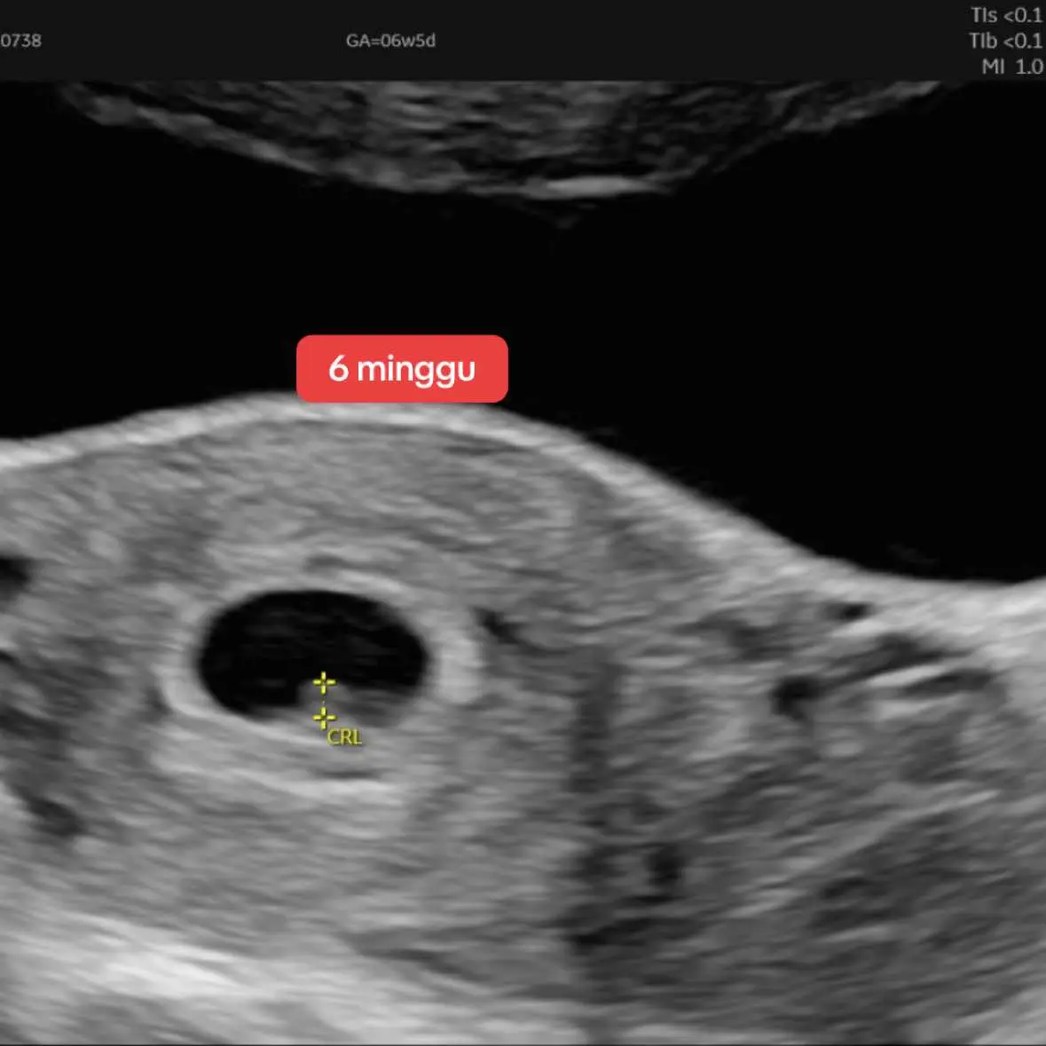Mommies pregnant berapa minggu tu? Ada alahan tak?🤭 #scanbaby #pregnant #earlypregnancy #ultrasound #awalkehamilan 