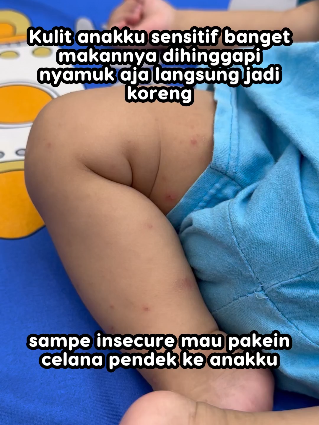 Atasi Bekas Luka dengan Hiboo All Purpose Baby Balm #hiboo #skincarebayi #hibooallpurposebabybalm