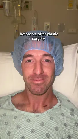 Can hardly tell the difference 🤣 #husbandwife #plasticsurgery #beforeandafter #humor #nosejob 