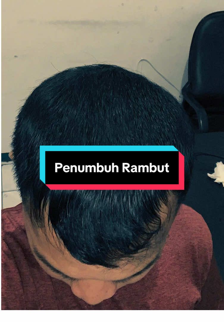 Minoxidil Norvine#minoxidil #dhtblockers #telogeneffluvium #norvineminoxidil #