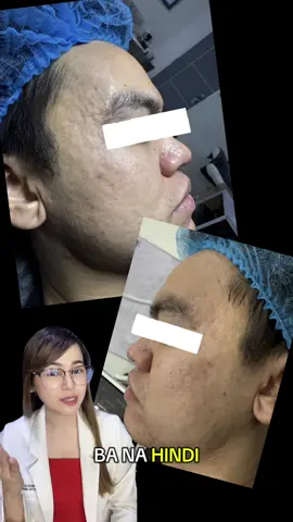 Narinig mo na ba ang acne scar subcision? 💉 Ito ‘yung procedure na tinatanggal ang malalim na acne scars mula sa ilalim ng balat! #pimples #AcneScars #acnesolution #acneproneskin  #CapCut 