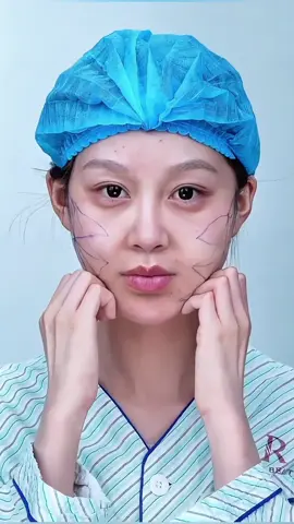 Babyface幼态脸打造#beauty#幼态脸 #babyface #上海整形 #facelift   