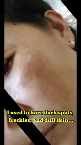 “Melasma? Acne marks? Wrinkles? GONE! 👋” #NoMoreDarkSpots #glowingskin #skinwhitening #pigmentation #beauty #darkspots #antiaging #wrinkles #homemade #skincare #freckles#VGO#vgobeauty L-QBS783@user58124339129 