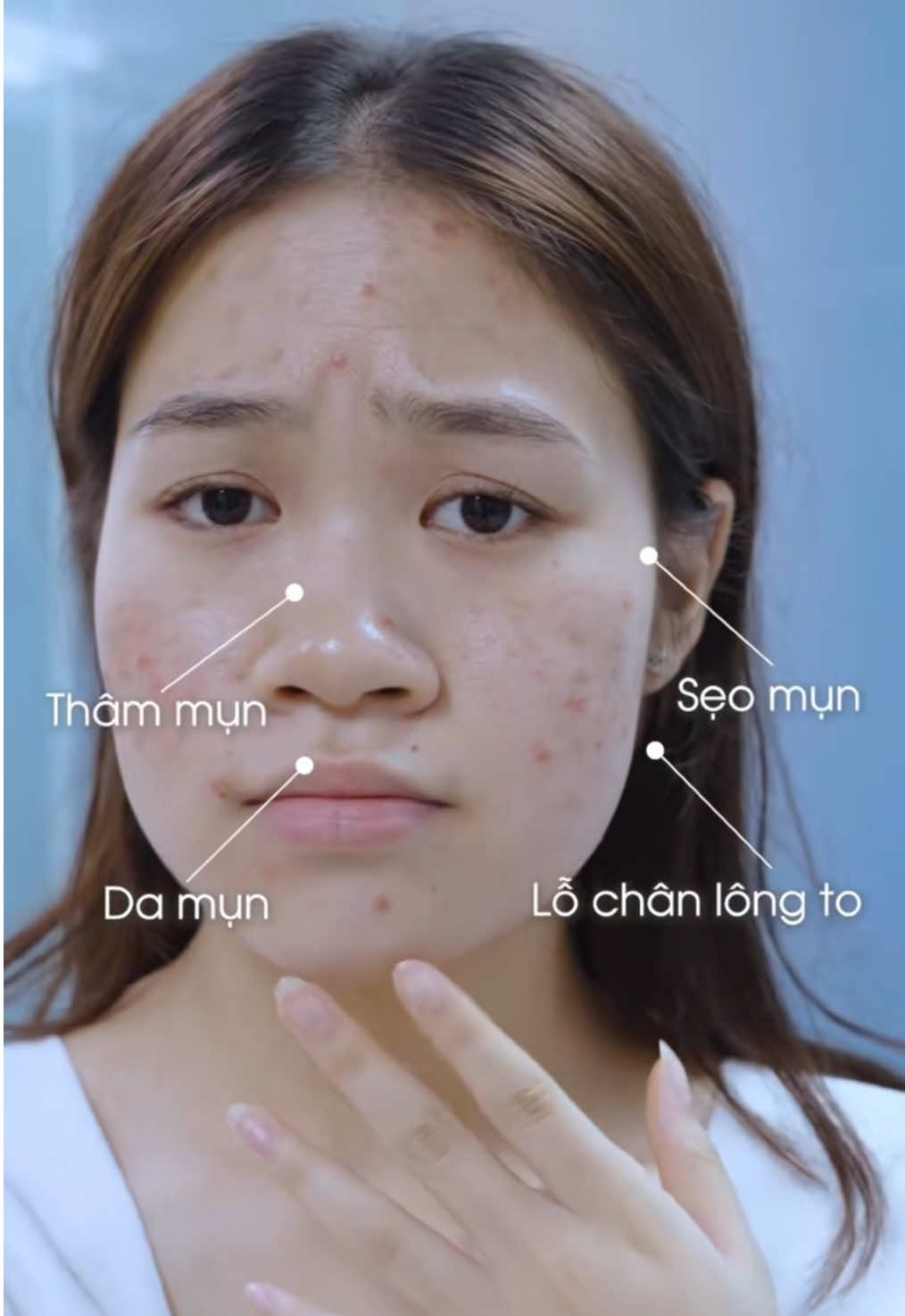 ƯU ĐÃI GIẢM 80% NGAY HÔM NAY Bác sĩ đang có liệu trình điều trị làn da mụn viêm nhiễm, mụn tái đi tái lại nhiều lần do nhiễm corticoid Đặt lịch tư vấn, thăm khám ngay hôm nay để được nhận ưu đãi! Cam kết hiệu quả tới 90% - Để lại SĐT nhận tư vấn #dieutrimun #thaidoccorticoid 