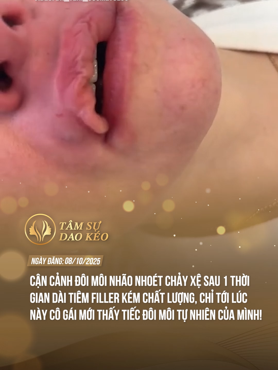 Tiêm filler kéo căng môi trong thời gian dài khiến cô gái phải nhận cái kết đắng! #tamsudaokeo #theanh28 #tiktoknews #thammy #fypツ