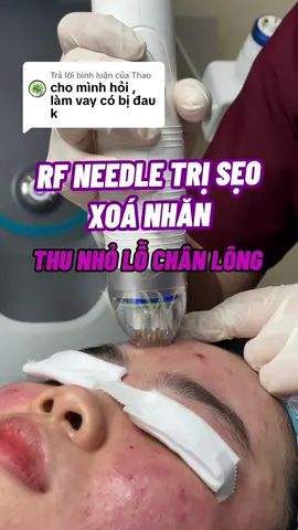 Trả lời @Thao Có phương pháp trị sẹo rỗ hiệu quả cao các bạn nên trải nghiệm là sóng RF vi điểm,nhanh lành, trẻ hoá da thích hợp cho bạn sợ đau nha 👋 #bacsiviwi #rftriseo #triiseorokhongdau #seorohieuqua #rfneedletriseo
