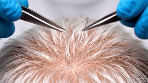 #สิวหัวดำ #blackhead #satisfying #hairstyle #pimple 