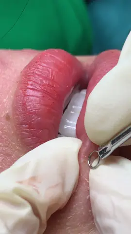 Đỏ#nanmunbangtambong#chamsocdaseo#chamsocda#chamsocdamun#chamsocdanam     