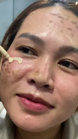 Hút sắc tố không sưng không đỏ #peel #lamdep #phuonganh 