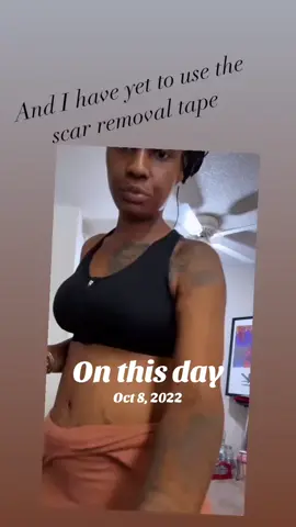 #onthisday #vsgjourney #tummytuck #vsgcommunity #foryoupage 