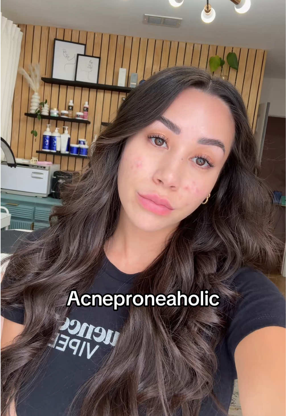 Brb about to burn my face off with another laser + peel #acne #acneprone #pimple #acnejourney #hormonalacne 