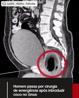 🔍 Caso inusitado na medicina legal: um homem deu entrada no Hospital de Emergência e Trauma de João Pessoa após introduzir um coco no reto, provocando intenso sangramento e dores abdominais. Segundo socorristas, ele perdeu bastante sangue e precisou passar por cirurgia para retirada do objeto. O caso ocorreu em Belém, na Paraíba, e foi confirmado pela unidade de saúde. Fonte: https://www.metropoles.com/brasil/socorrista-fala-sobre-atendimento-a-homem-com-coco-no-anus-audio #MedicinaLegal #PeríciaMédica #CasosReais #CorpoEstranho #EmergênciaMédica  Posted @withregram • @medlegaljuridica 
