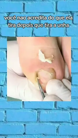 #CapCut Manicure / podóloga  #unhas #react #unhasencravadas #podologia 
