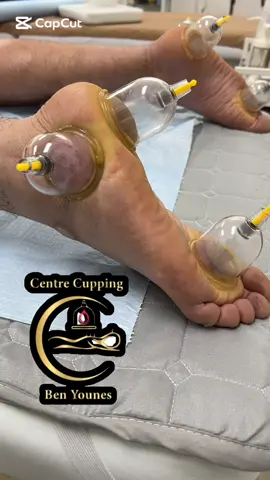 #حجامة #حجامة_نبوية_بطريقه_علمية #cupping #فرنسا🇨🇵_بلجيكا🇧🇪_المانيا🇩🇪_اسبانيا🇪🇸 #الشعب_الصيني_ماله_حل😂😂  