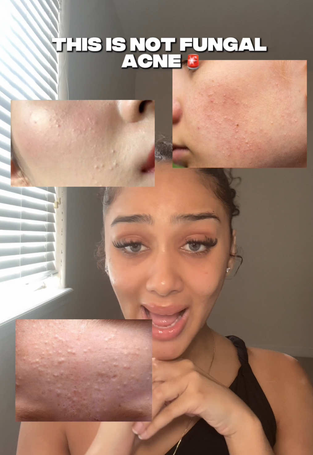 hydrated, calm, & glass-skin vibes only ✨🪞 #anuaazelaicacidserum #closedcomedones #acnescars #koreanskincare #fungalacne #anuapartner #glowuptips 