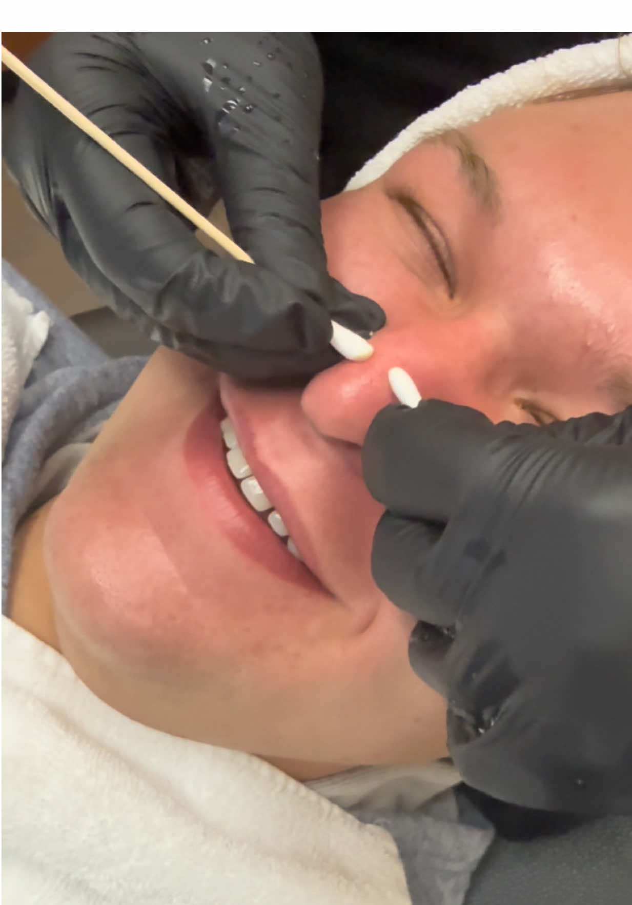 A chemical peel with me! 🫧😦 #fyp #foryoupage #comedy #chemicalpeel #skincare 