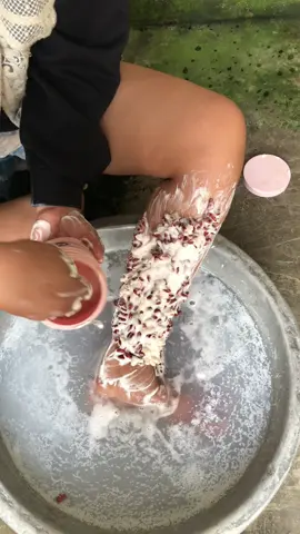 Omg ticks😫#removal#lice#omg#ticks