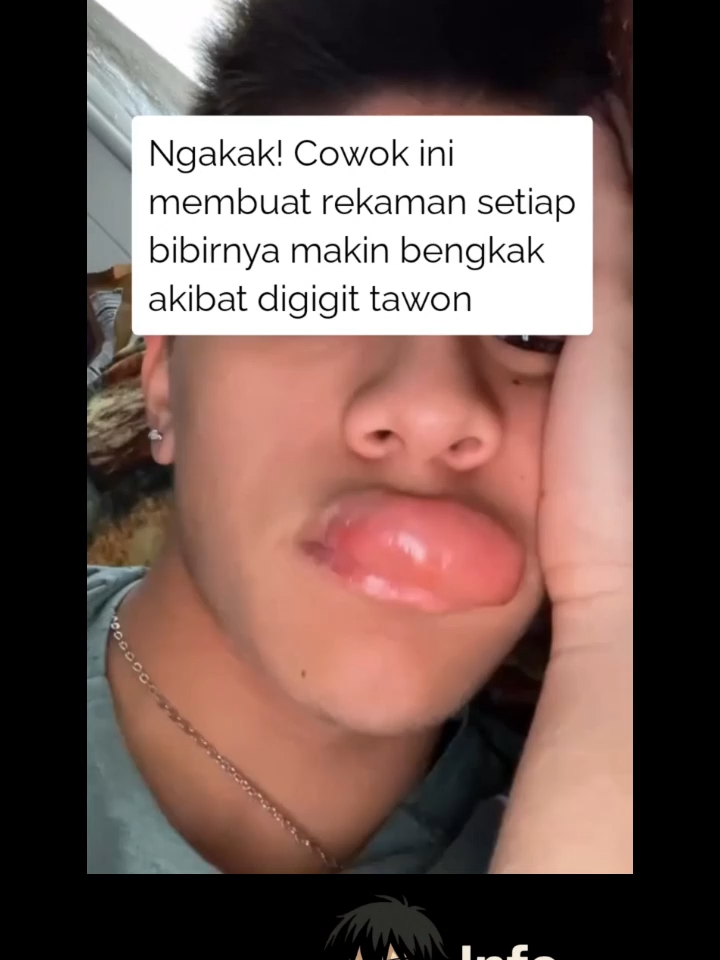 Ngakak Parah! Cowok Ini Rekam Perubahan Bibirnya Setelah Digigit Tawon 😭🐝 Video ini sukses bikin netizen ngakak! 🤣 Seorang cowok nekat bikin dokumentasi perubahan bibirnya setelah digigit tawon — dari awal cuma bengkak sedikit, sampai akhirnya makin besar dan bikin ekspresinya makin lucu! 😭 Warganet langsung ramai di kolom komentar, ada yang kasihan, ada juga yang ngakak nggak berhenti. Emang ya, kalau udah kejadian kayak gini antara sakit dan lucu tuh tipis banget! 😂 Kamu pernah ngalamin hal absurd kayak gini juga nggak? Tulis di kolom komentar ya 👇 vidio di ambil dari @Jordy  #ngakak #fyp #viralvideo #lucuparah #komediviral 