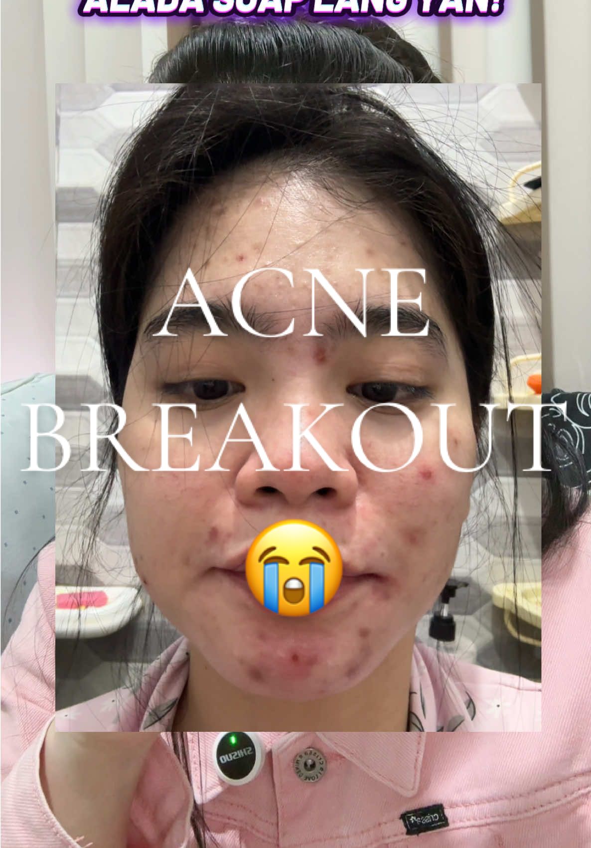 #alada #aladasoap #aladathailand #acne #acnetreatment 