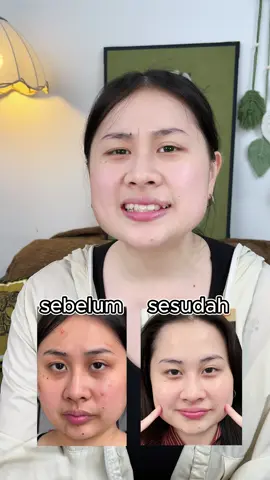 Sista yang pori-portinya gedye plus komedoan, wajib cobain green clay cleanser Korea ini! #GlowUpChallenge #DiskonAkhirBulan  #ForYouBeauty #pembersihwajah #Jerawat #bekasjerawat #kulitkusam #skincaremencerahkan    #PerawatanKulit   #TipsKecantikan   #WajahBersih #RutinitasSkincare  #KulitSehat   #Komedo  #Jerawat #BebasJerawat  Q#sabun  #skincareroutine#fyp#LY 