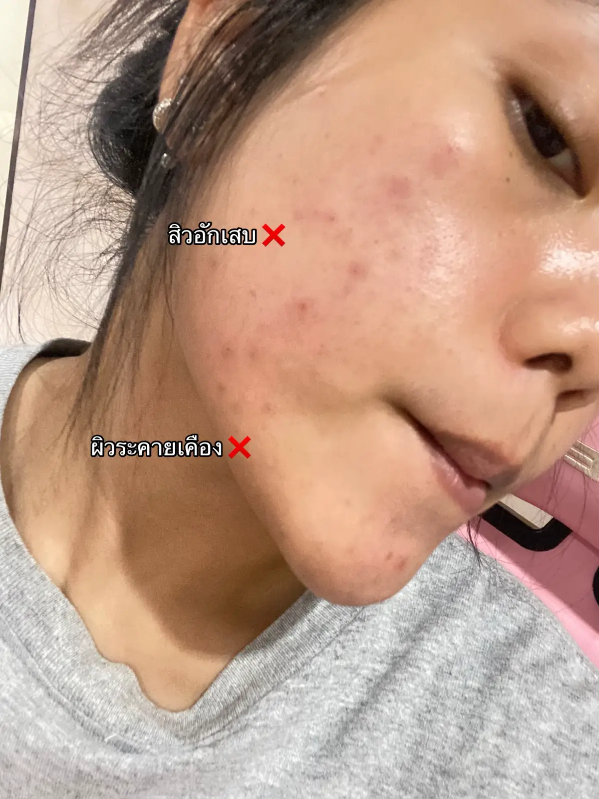 #น้ำตบหยุดสิว #น้ำตบหยุดสิวบาล์มบู #น้ําตบหยุดสิวblahmbooh #blahmboohthailand 