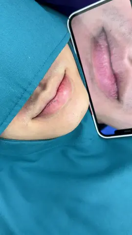 Tạo hình môi tim cho nam #catmoitim #cắtmôi #ilovetiktok #lovetiktok #xuhuong 