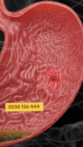The Best And Effective Organic Products That Helps To Heal Stomach Ulcer,  Peptic Ulcer, Gastritis, Acid Reflux And Eradicate H pylori Bacteria Completely For You. #creatorsearchinsights #supplementsthatwork #foreverlivingproducts #ulcer #foryou 