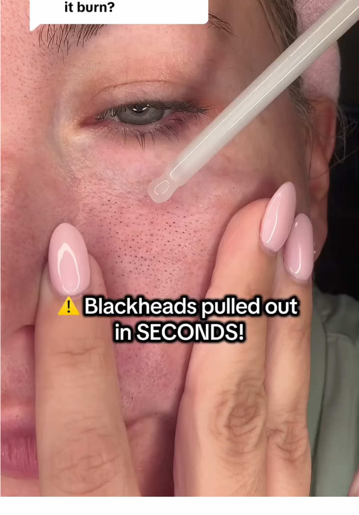 Link in bio🔗 -50% OFF now💫 White rice serum used on more delicate areas such as your face & neck. The black rice serum is perfect for more rough and bumpy areas💆🏻‍♀️Both are perfect for sensitive skin💫 #fyp #peelshot #exfoliate #drmelaxinpeelshot#blackheads