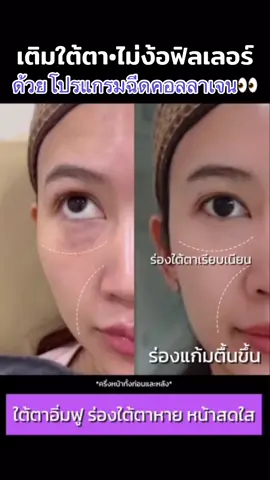เติมใต้ตาไม่เป็นก้อน💟#เติมใต้ตา #ใต้ตาคล้ํา #ใต้ตาดํา #ใต้ตากระจ่างใส #ใต้ตาคล้ําภูมิแพ้ 