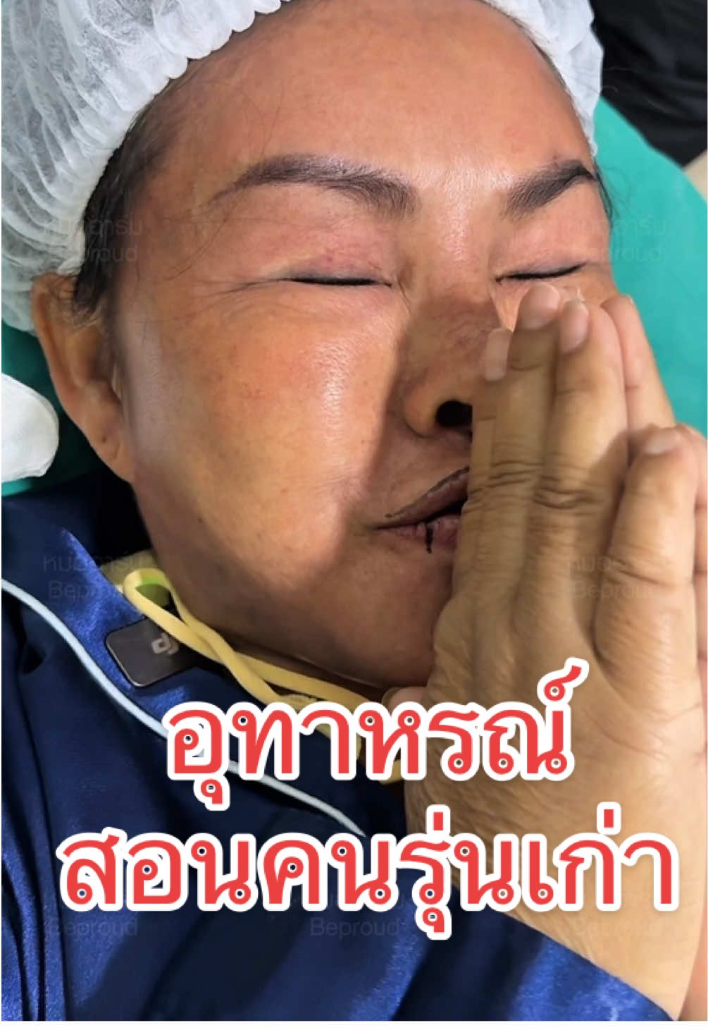 อุทาหรณ์สอนคนรุ่นเก่า #หมออาร์มบีพราวด์คลินิก #ปากกระจับปีกนางฟ้า #beproudclinic #ศัลยกรรมเปลี่ยนชีวิต #รีวิวบิวตี้ในtiktok  @หมออาร์ม บีพราวด์  @หมออาร์ม บีพราวด์  @หมออาร์ม บีพราวด์ 